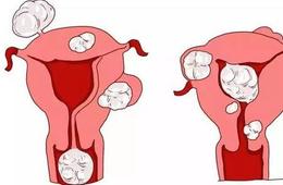 消除子宫肌瘤的3种方法