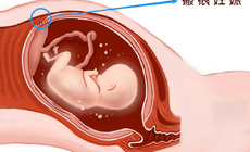 剖宮產瘢痕妊娠就是一個“炸彈”，看專家如何“拆彈”