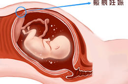 剖宮產瘢痕妊娠，一旦發現請盡快處理