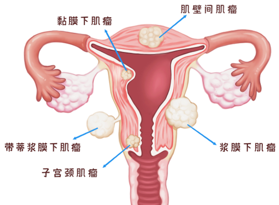 绝经后，子宫肌瘤是不是不需要治疗了？