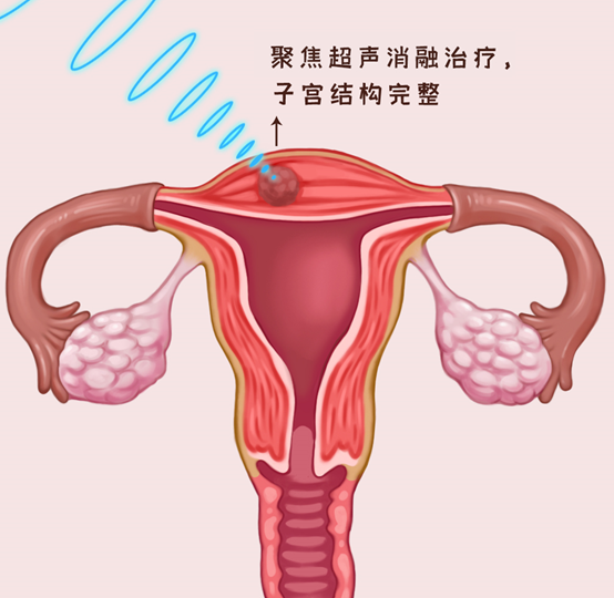 子宫肌瘤在做聚焦超声消融术后多久能消失