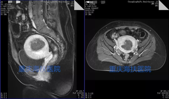 多囊患者+子宫腺肌病，也能收获双胞胎宝宝