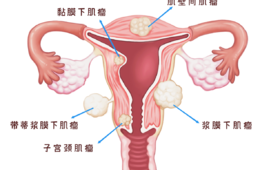 子宫肌瘤变性是什么意思？