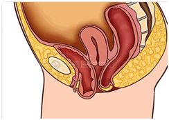 4张图，带你了解常见的盆腔器官脱垂