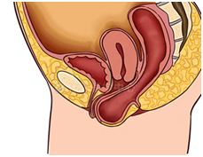 4张图，带你了解常见的盆腔器官脱垂