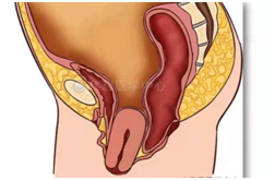 4张图，带你了解常见的盆腔器官脱垂