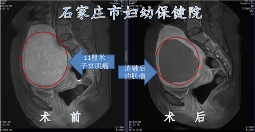 11厘米肌瘤，在石家庄市妇幼保健院不开刀就能治