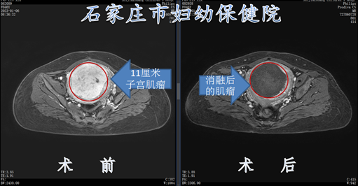 11厘米肌瘤，在石家庄市妇幼保健院不开刀就能治
