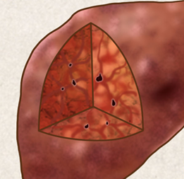 转移性肝癌晚期，如何体面的度过最后的时间