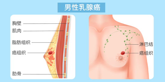 男性也会得乳腺癌吗，有什么表现？