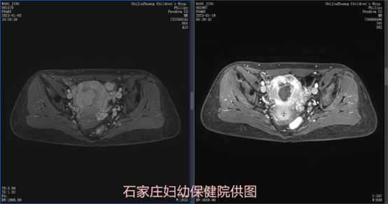 开刀剥除肌瘤后又复发，这次该如何治疗？