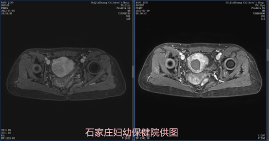 开刀剥除肌瘤后又复发，这次该如何治疗？