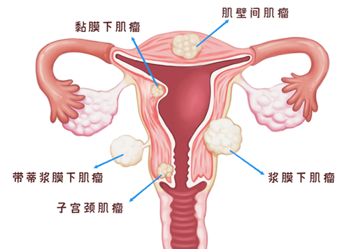 不同位置的子宫肌瘤如何选择手术方式？