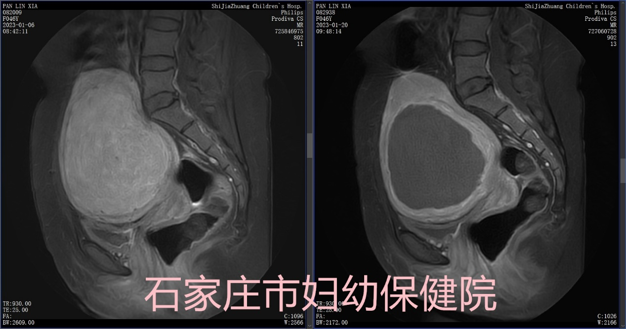 一把无形的刀，专治有形的瘤