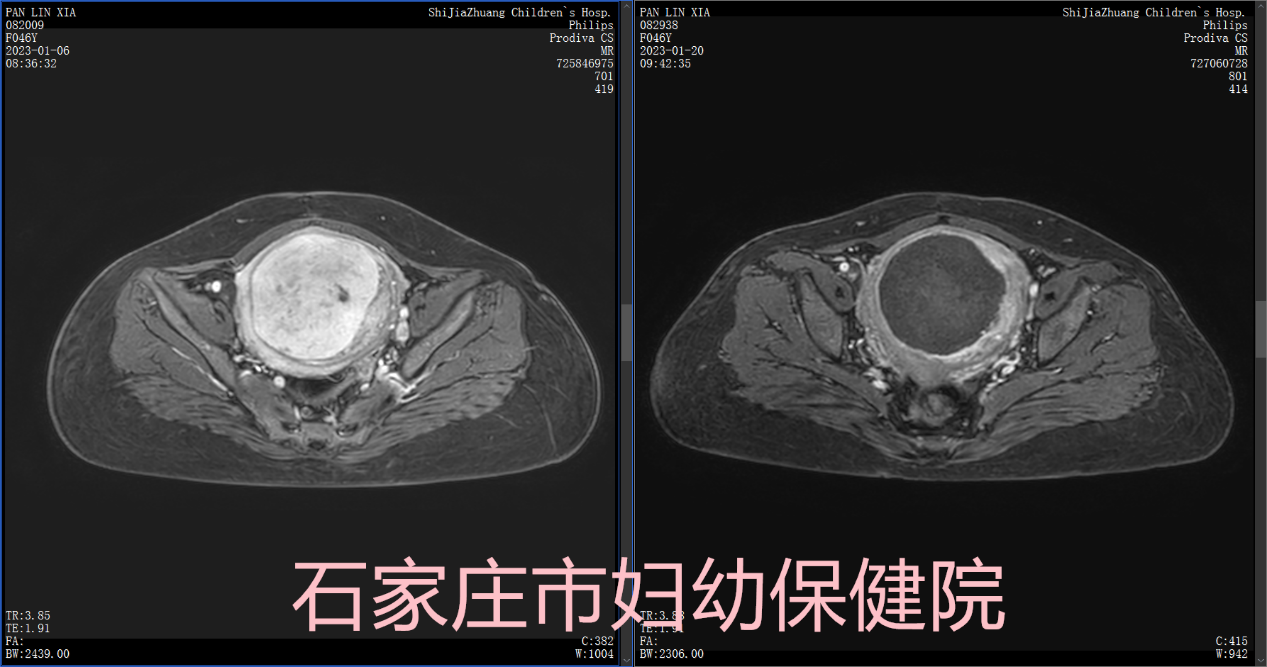 一把无形的刀，专治有形的瘤