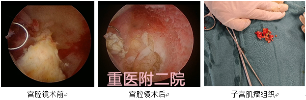 恢复快、不开刀、术后即刻下床 HIFU治疗子宫肌瘤如此厉害