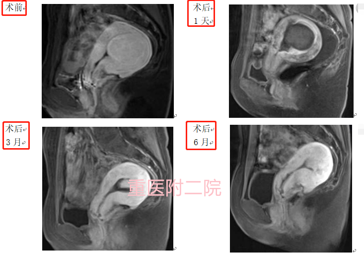 恢复快、不开刀、术后即刻下床 HIFU治疗子宫肌瘤如此厉害