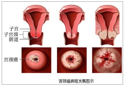 预防宫颈癌只打疫苗还不够