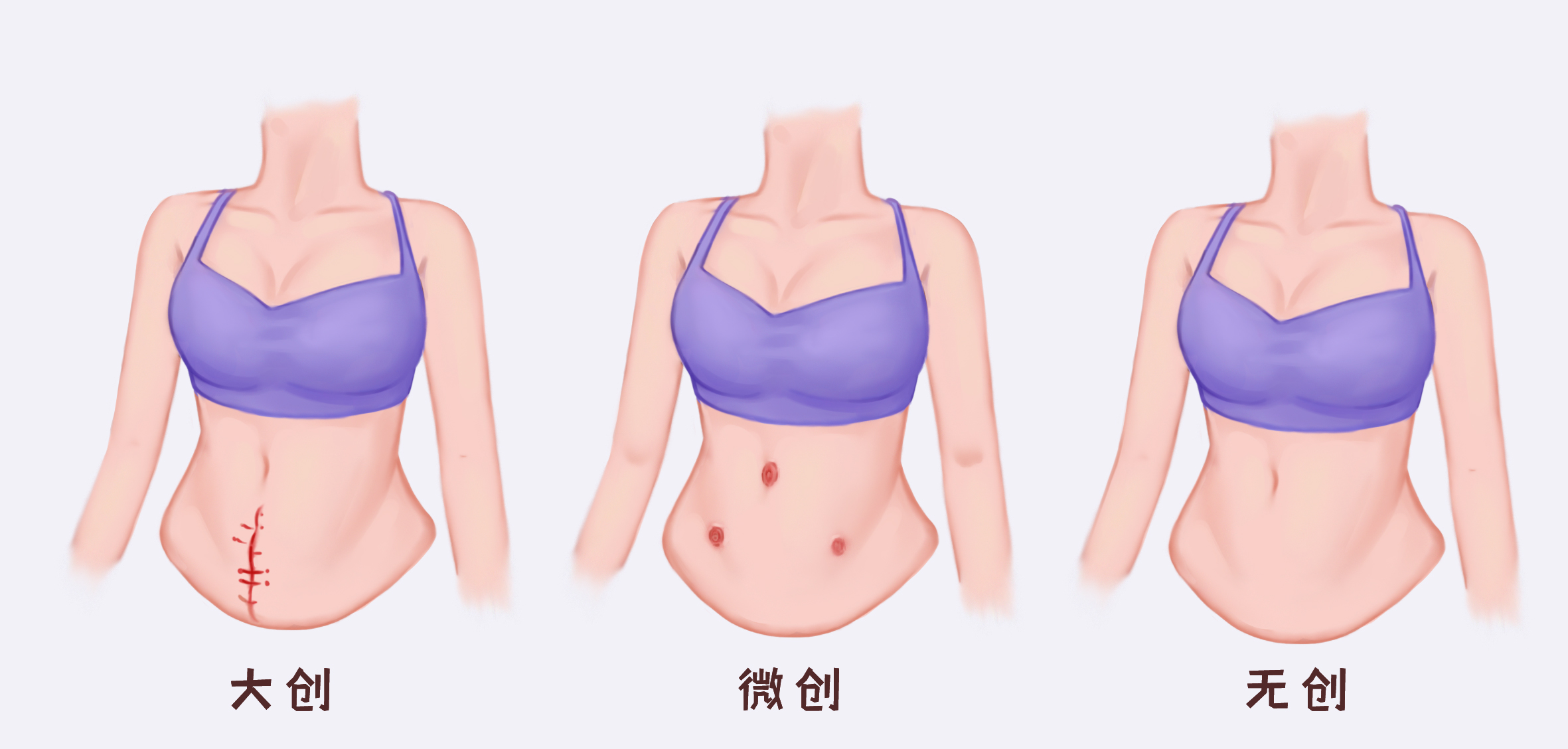 专家支招：子宫肌瘤治疗方式“PK”一览