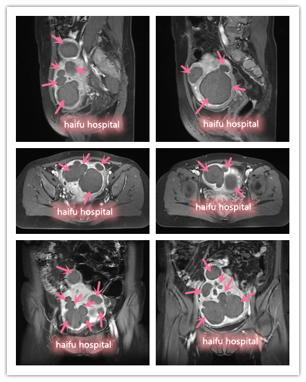 典型案例|子宫增大如怀孕5月， “海扶刀”团灭多发性子宫肌瘤