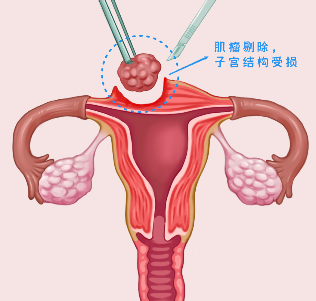 子宫肌瘤术后发热是什么原因导致的