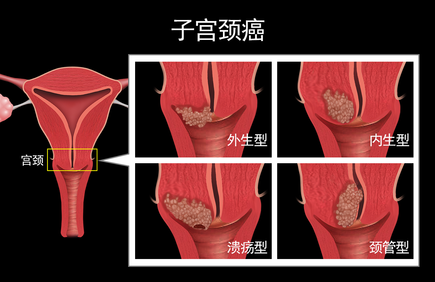 肌瘤和肿瘤有什么区别