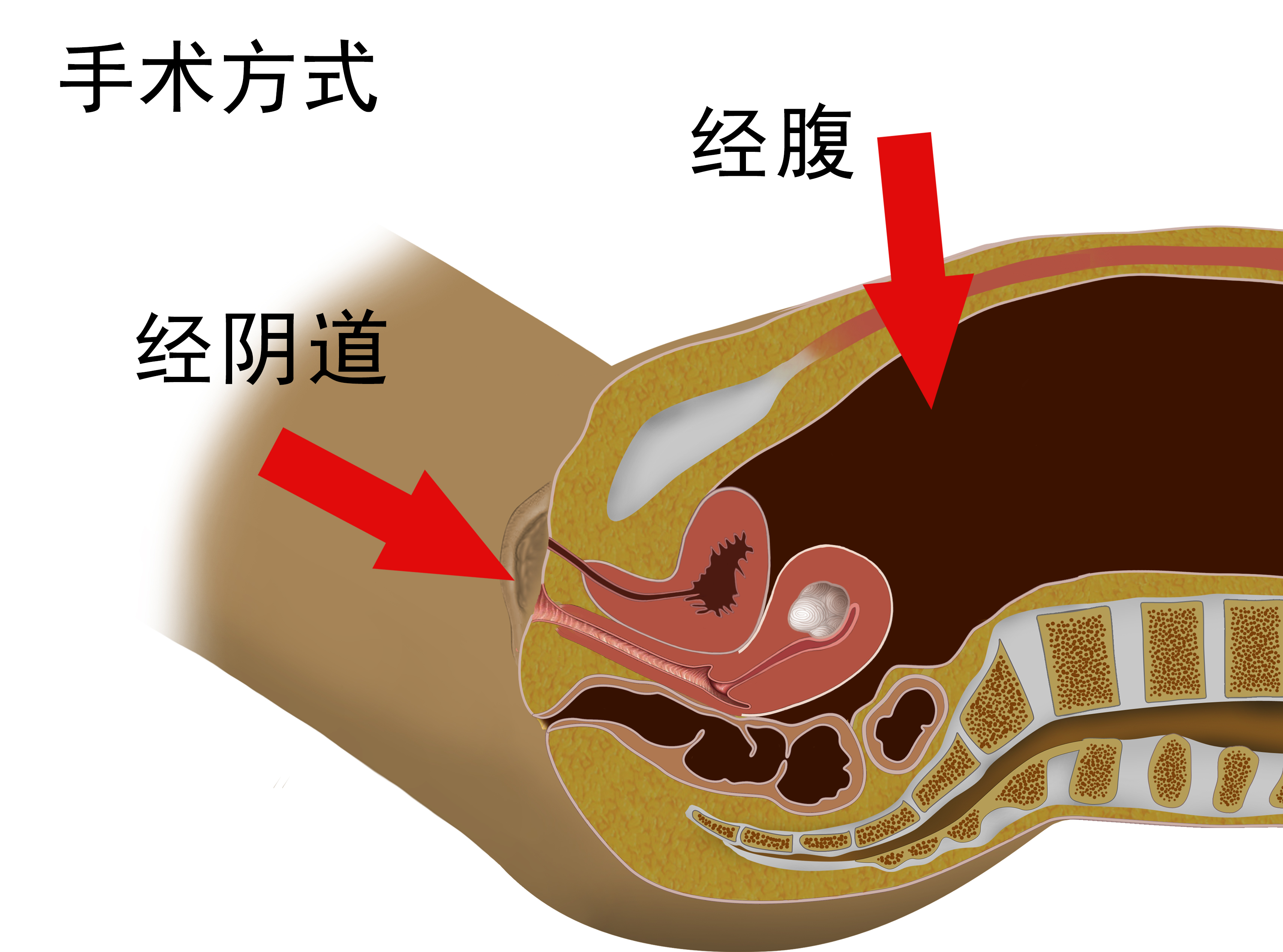 子宫肌瘤开腹手术后半年肚子变大