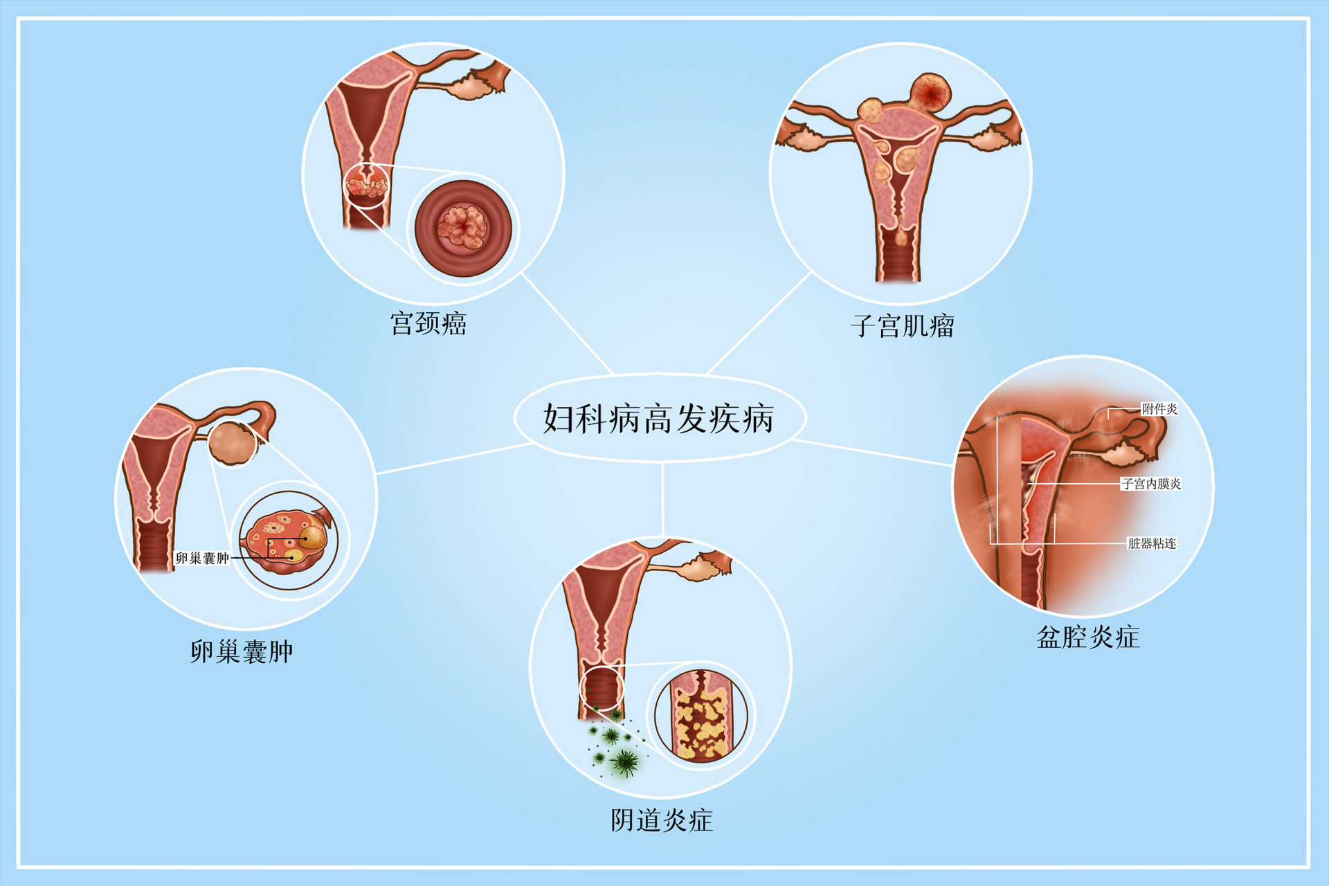 又到了妇科病喜欢的夏季，女性应该如何应对？