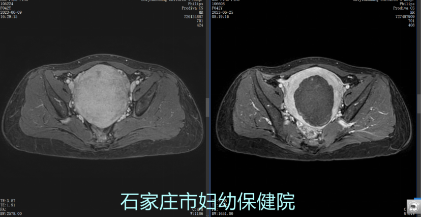 才42岁，就让她切子宫吗？