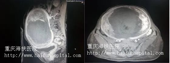 20公分子宫肌瘤，子宫还能保住吗