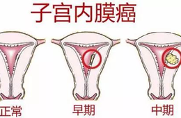 高風險女性群體：需格外警惕子宮內膜癌的發生