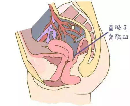 盆腔炎与不孕和宫外孕的关系：探究潜在的生理机制