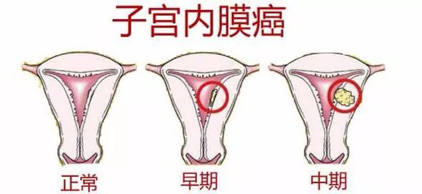 子宫内膜癌的症状：早期识别与预防