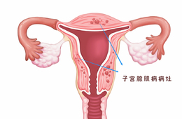 长“歪”的子宫内膜，是什么毛病？