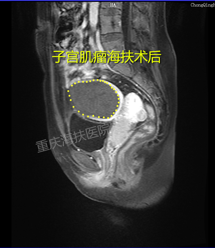 生育路上，她遇见10公分大的拦路虎.....