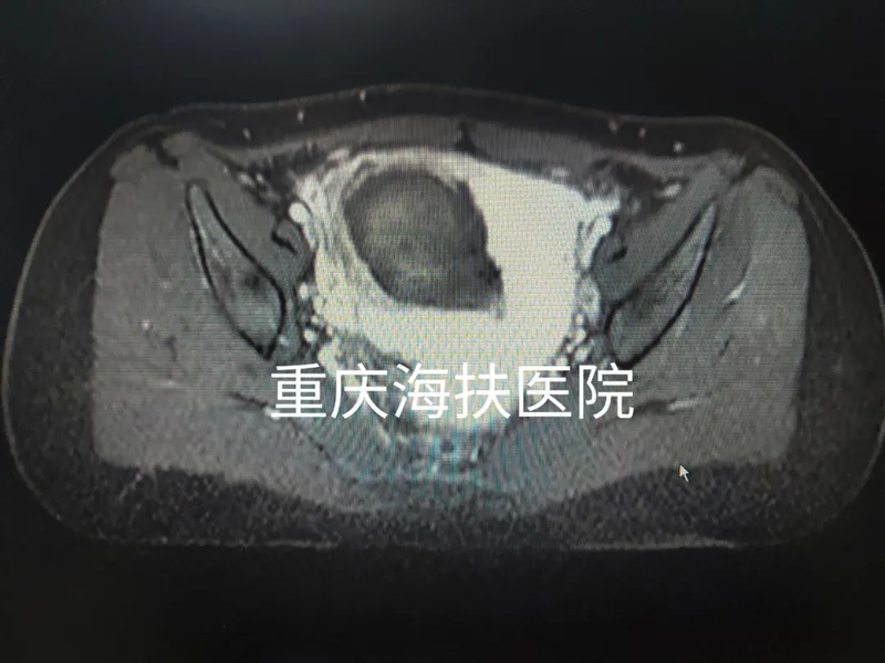 “海扶刀”设备对胎盘植入的效果如何？