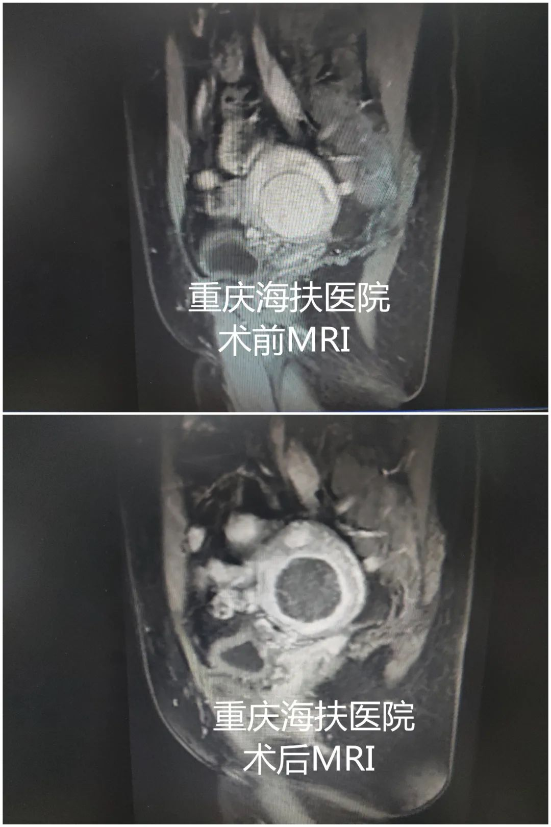 备孕六年无果，儿童节前夕她喜迎海扶宝宝诞生