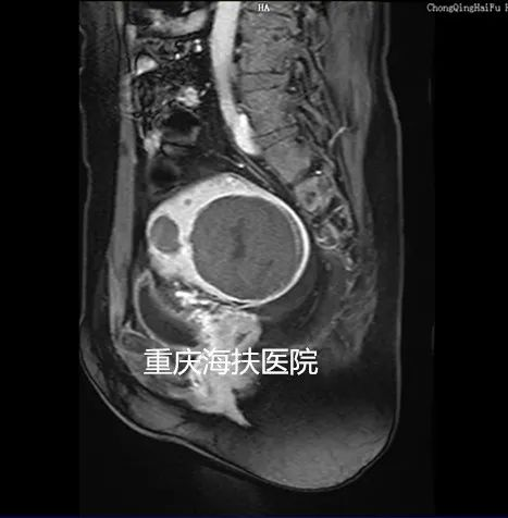 看图说话：聚焦超声消融术后1年