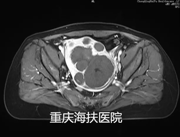 看图说话：聚焦超声消融术后1年