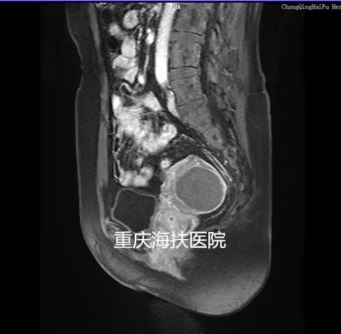 看图说话：聚焦超声消融术后1年