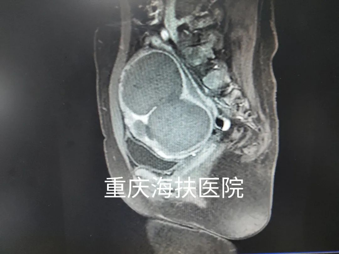 10+个肌瘤，手术挖瘤VS聚焦超声消融