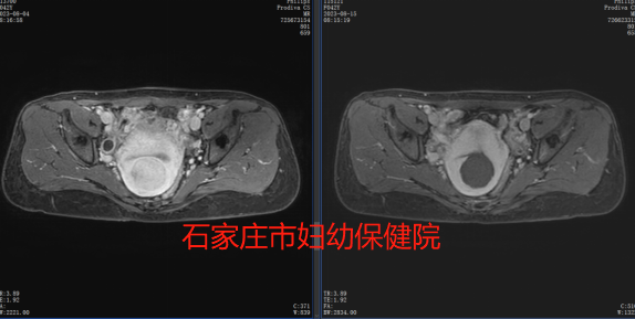 经量增多，一定要警惕这类子宫肌瘤！