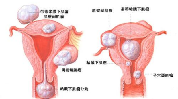 经量增多，一定要警惕这类子宫肌瘤！