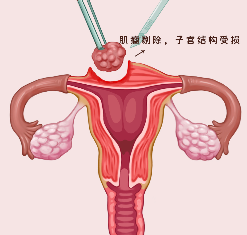 子宫肌瘤微创手术做完有点发烧