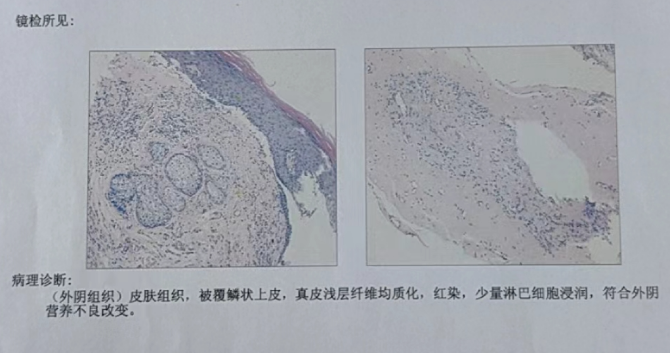 长期瘙痒背后的真相：外阴白斑病患者的心路历程