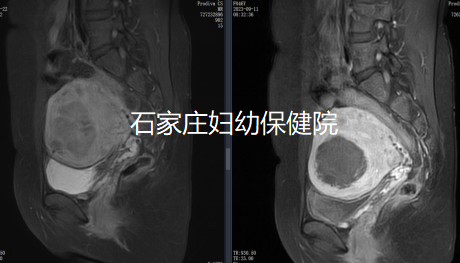 子宫肌瘤+重度贫血，她该如何保宫？