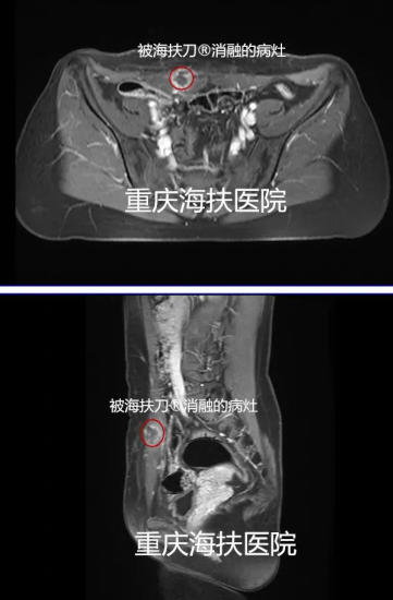 剖宫产瘢痕周期性疼痛，原因是……