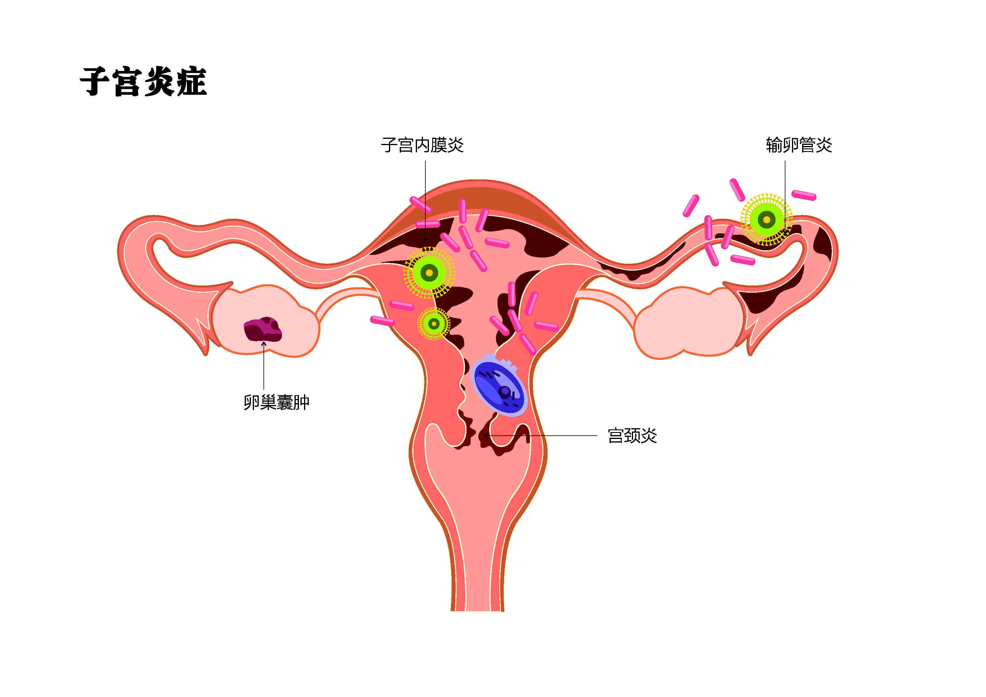 关于附件炎，这几点你要知道