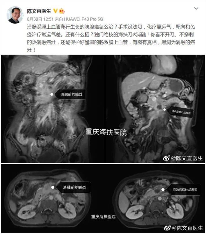 手术没法切，化疗靠运气，胰腺癌还有什么招？