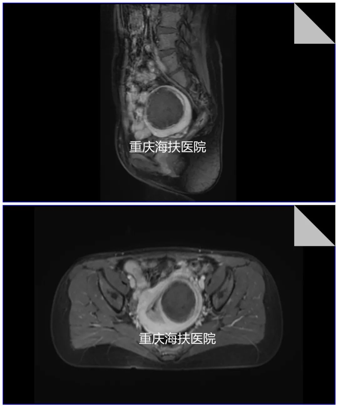 肌瘤阻挡，她收获了属于自己海扶小公主